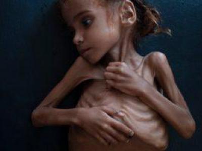 “امل حسین” دختر خردسال یمنی که دیگر لبخند نمی زند +تصاویر